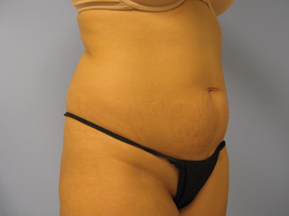 Tummy tuck Before & After Image