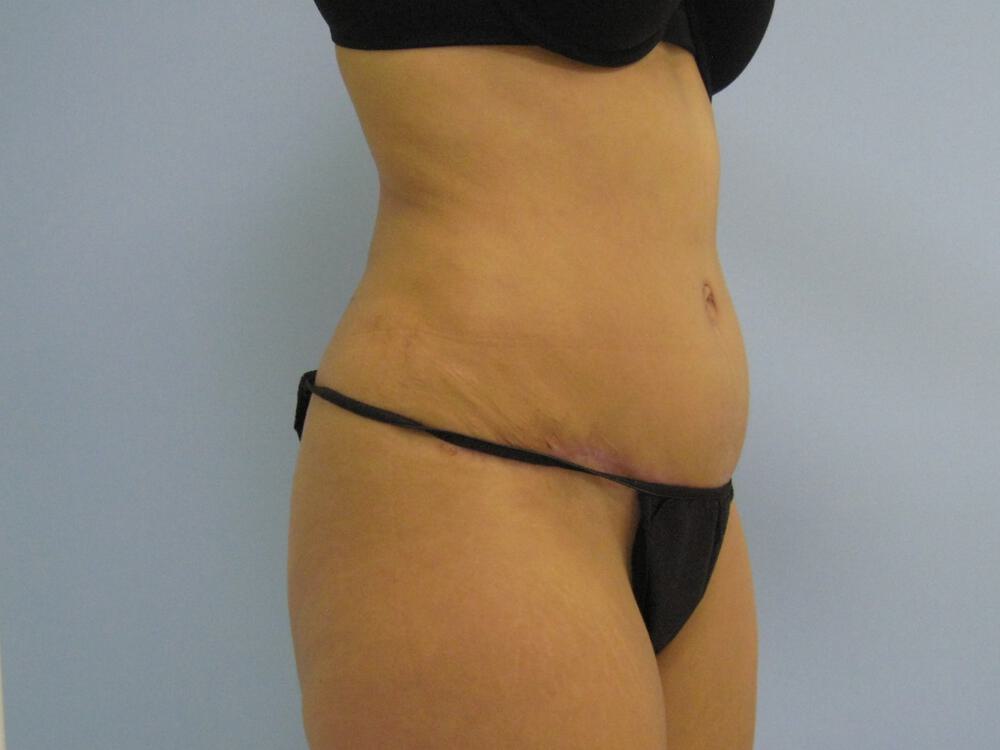 Tummy tuck Before & After Image