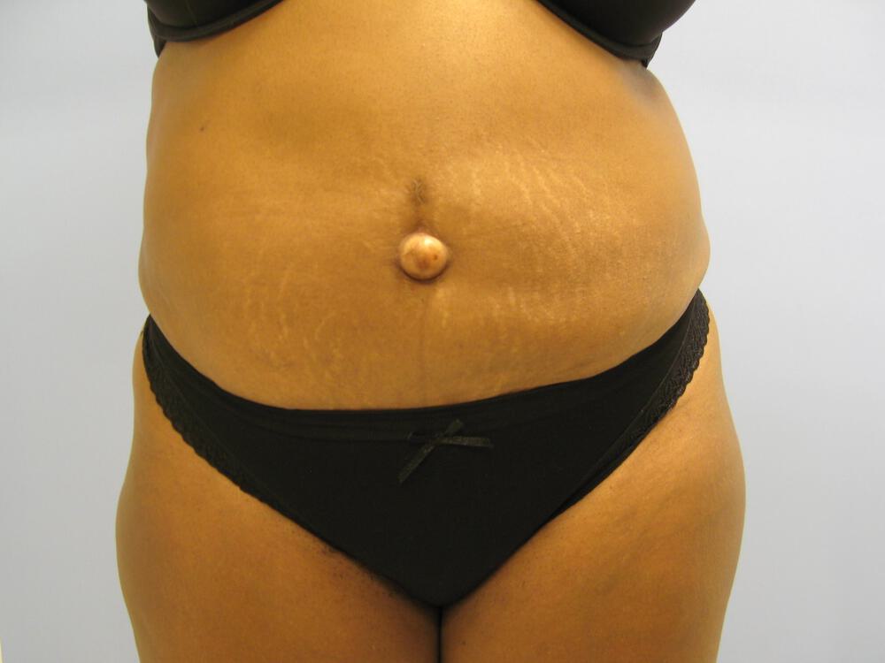 Tummy tuck Before & After Image