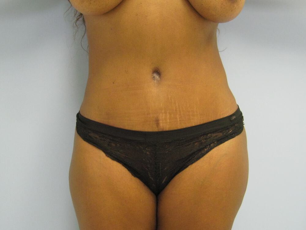 Tummy tuck Before & After Image