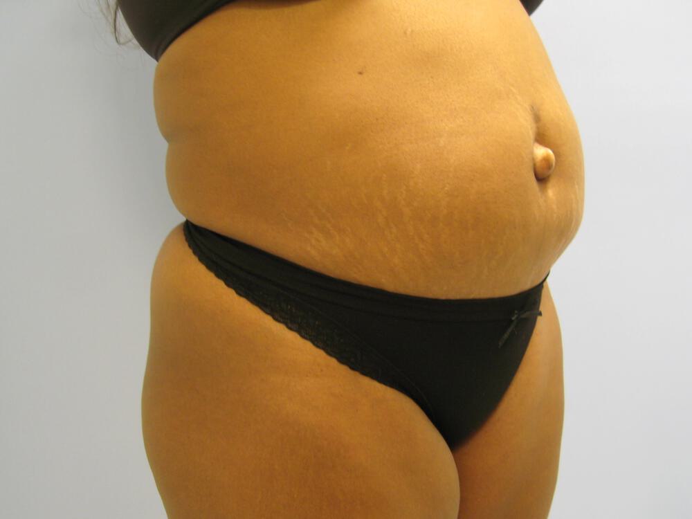 Tummy tuck Before & After Image