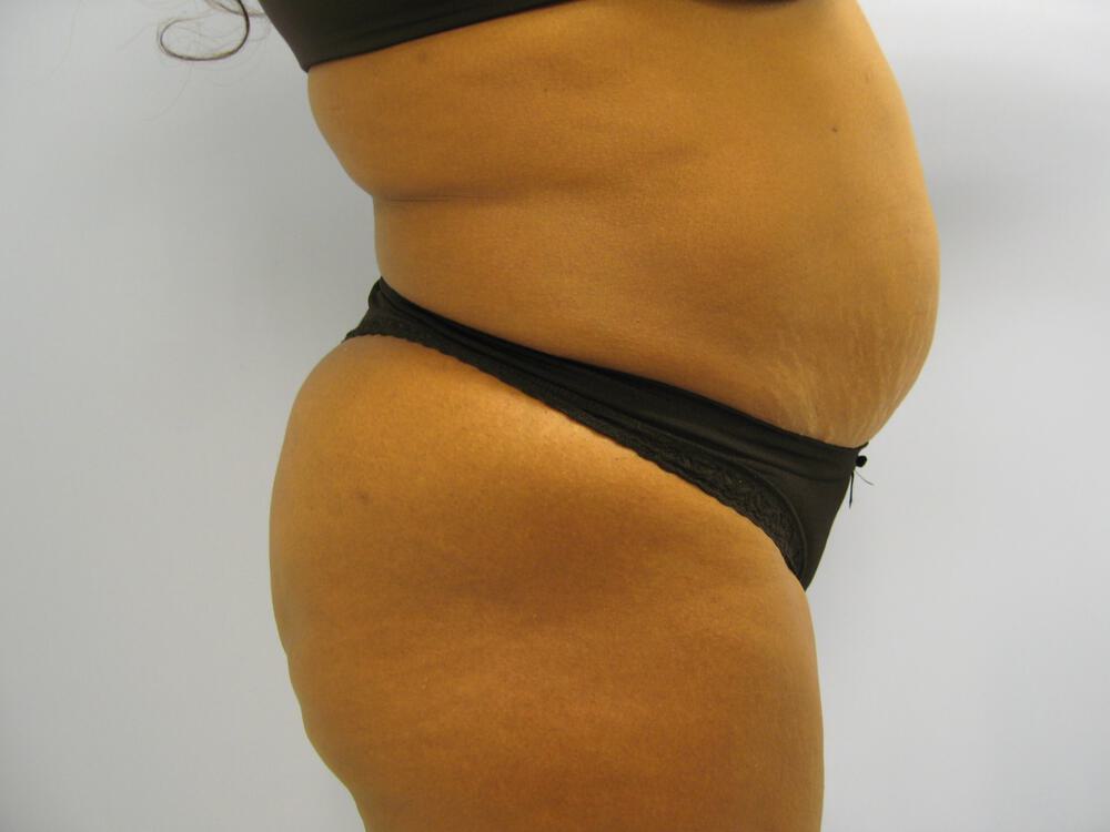 Tummy Tuck Before & After Image