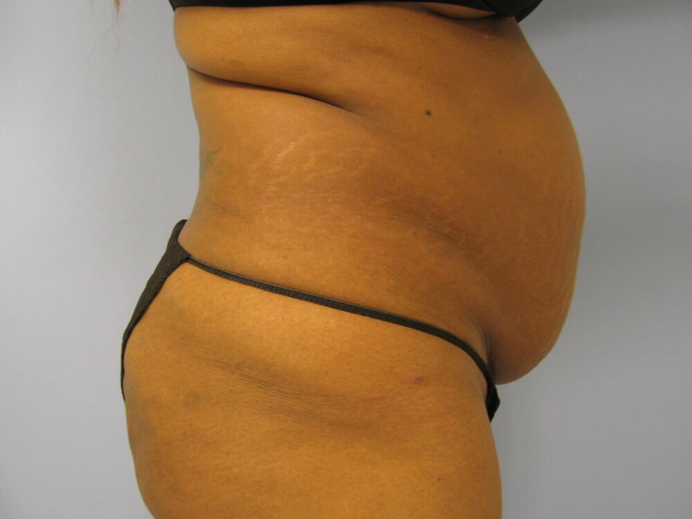 Tummy tuck Before & After Image