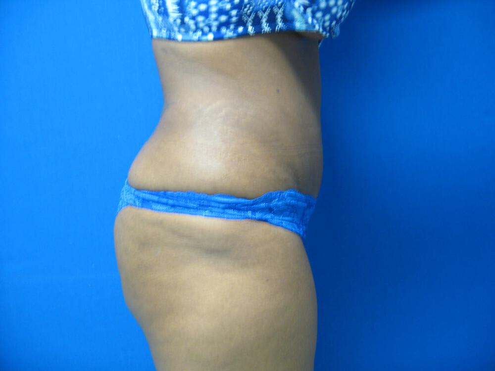 Tummy tuck Before & After Image