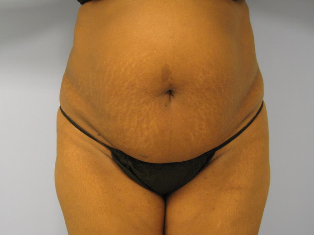 Tummy tuck Before & After Image