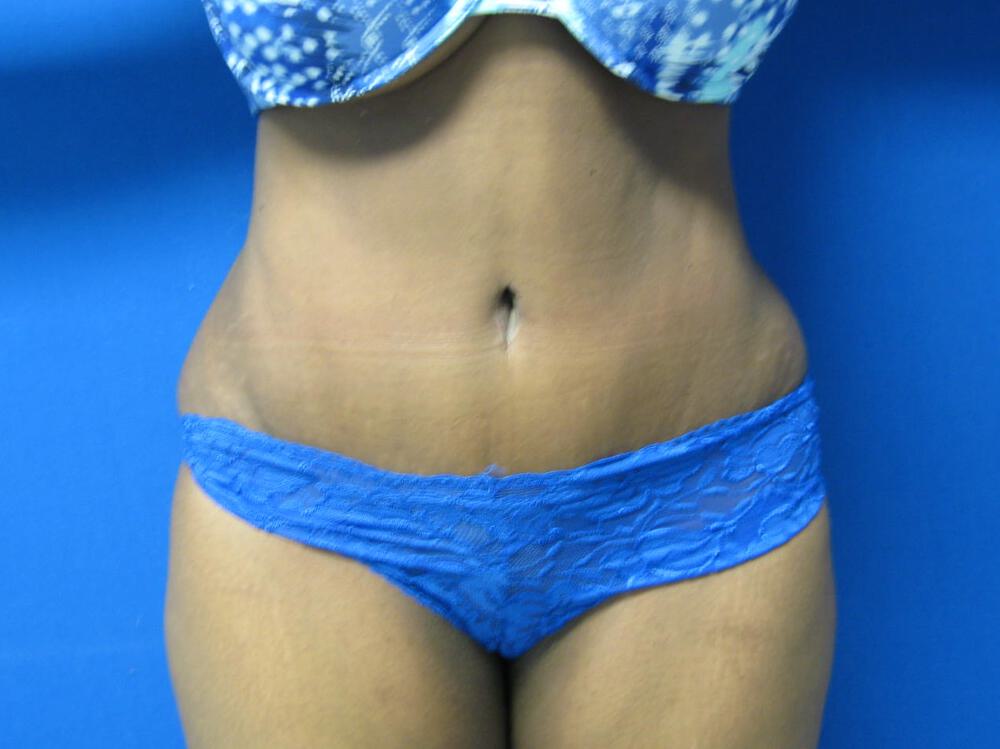 Tummy tuck Before & After Image