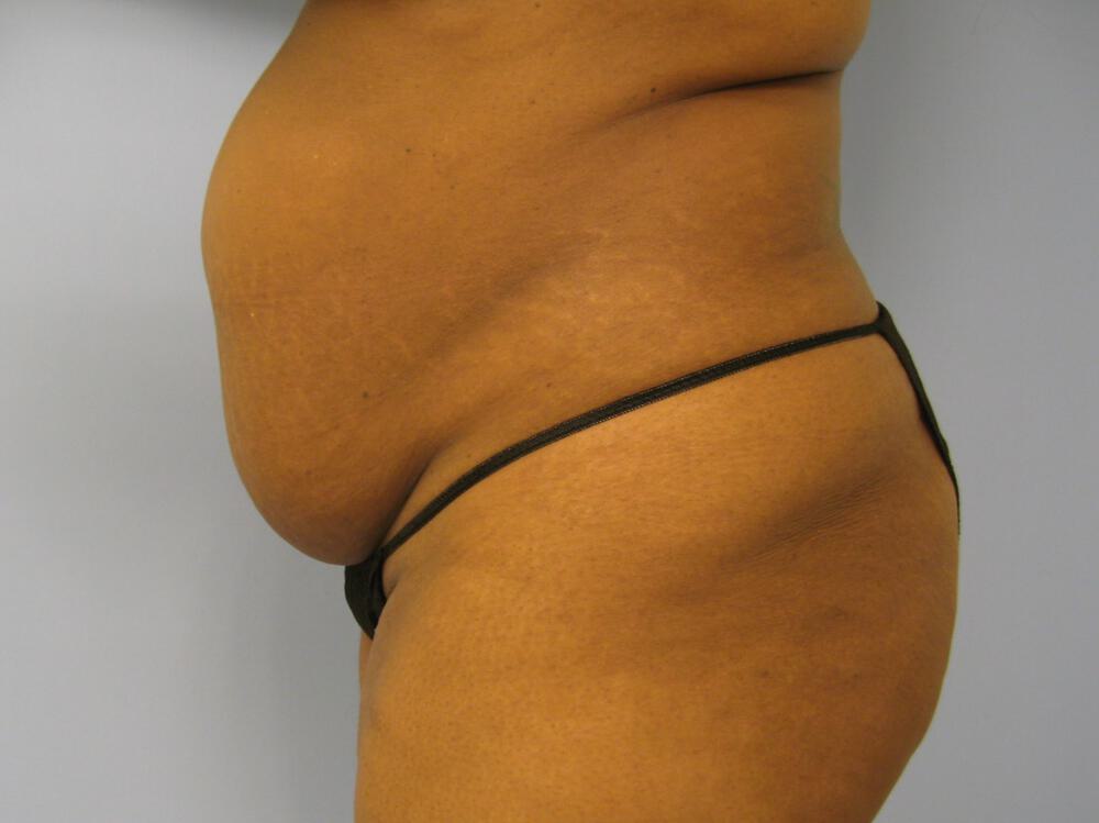 Tummy Tuck Before & After Image
