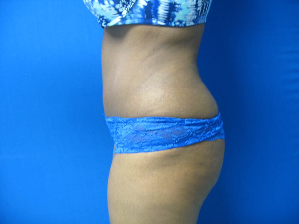 Tummy Tuck Before & After Image