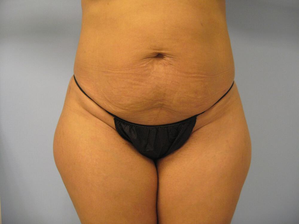 Tummy tuck Before & After Image
