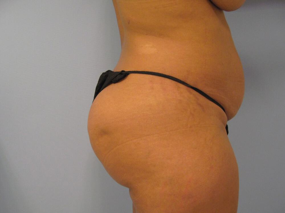 Tummy tuck Before & After Image