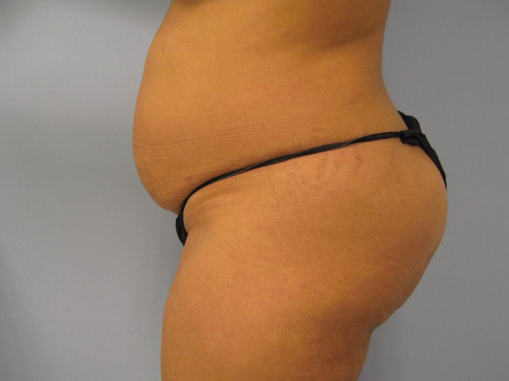 Tummy Tuck Before & After Image