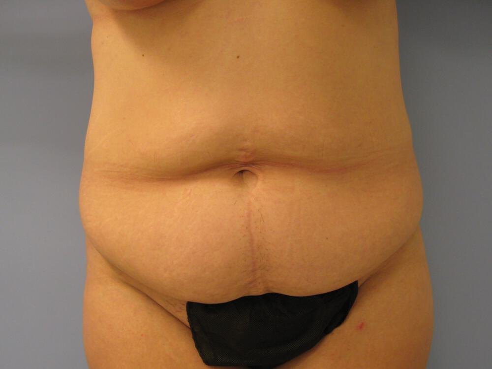 Tummy tuck Before & After Image
