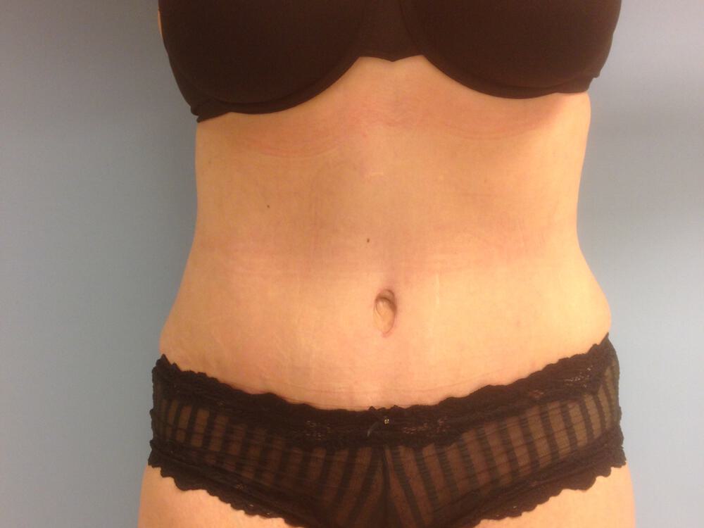 Tummy tuck Before & After Image