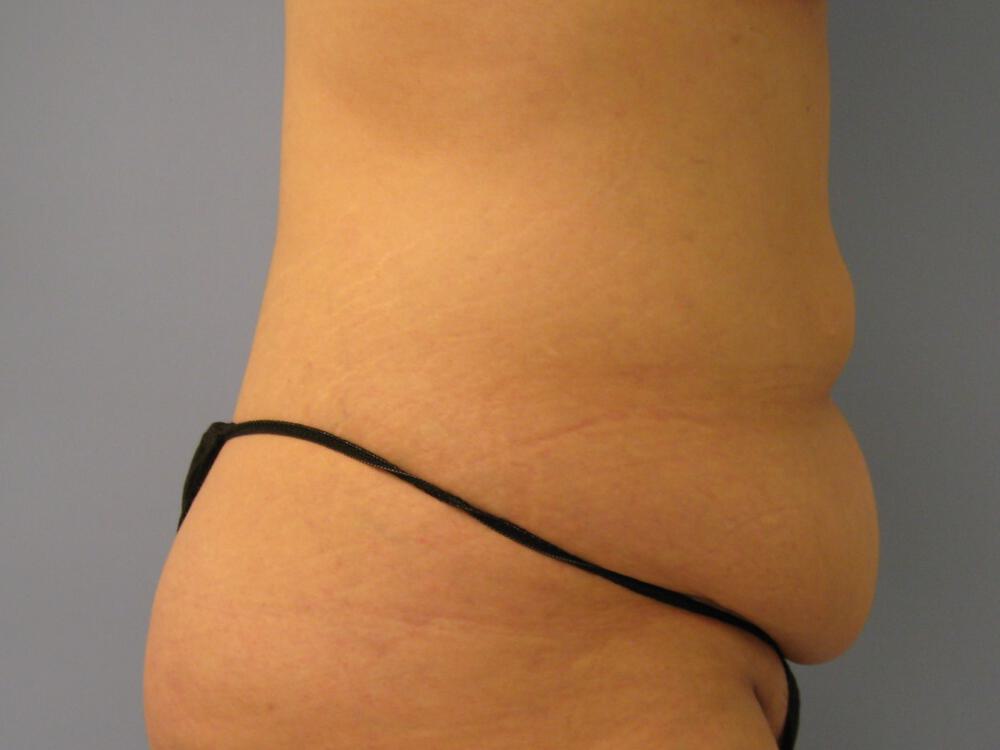 Tummy tuck Before & After Image