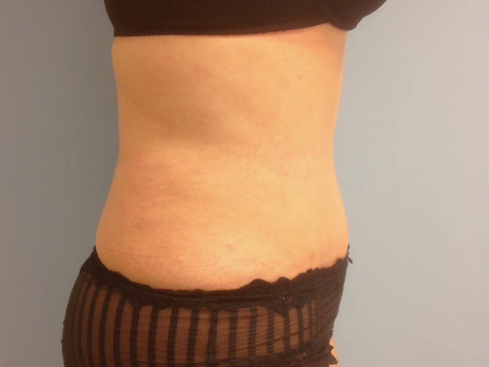 Tummy tuck Before & After Image