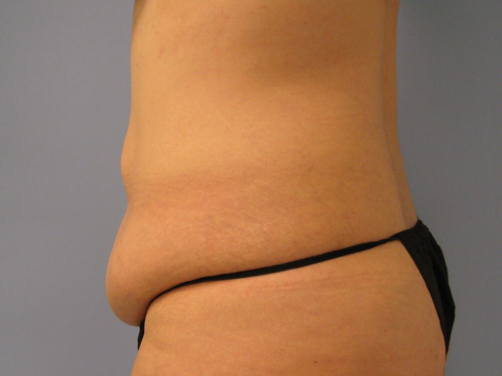 Tummy Tuck Before & After Image
