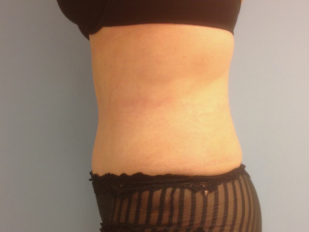Tummy Tuck Before & After Image