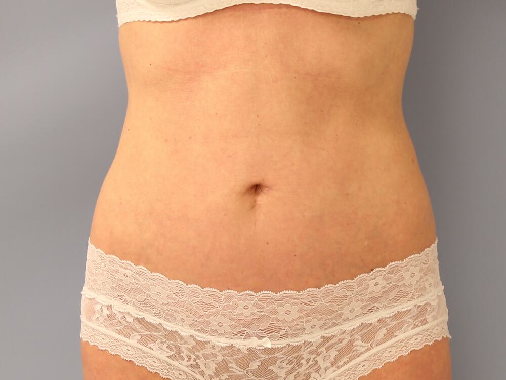 Tummy tuck Before & After Image
