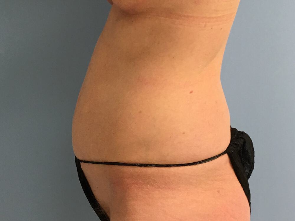Tummy tuck Before & After Image