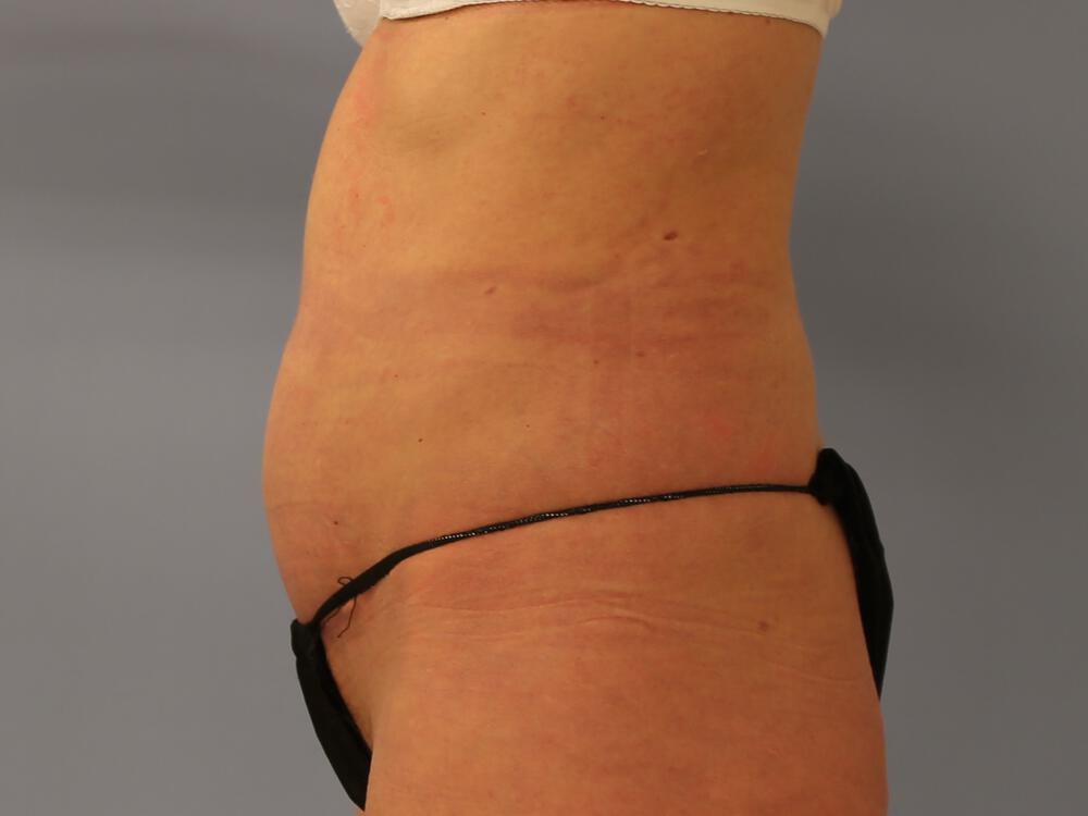 Tummy tuck Before & After Image
