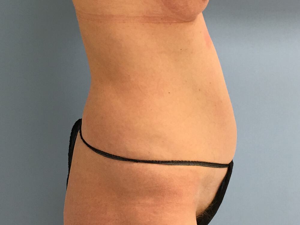 Tummy Tuck Before & After Image