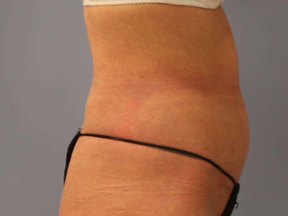 Tummy Tuck Before & After Image
