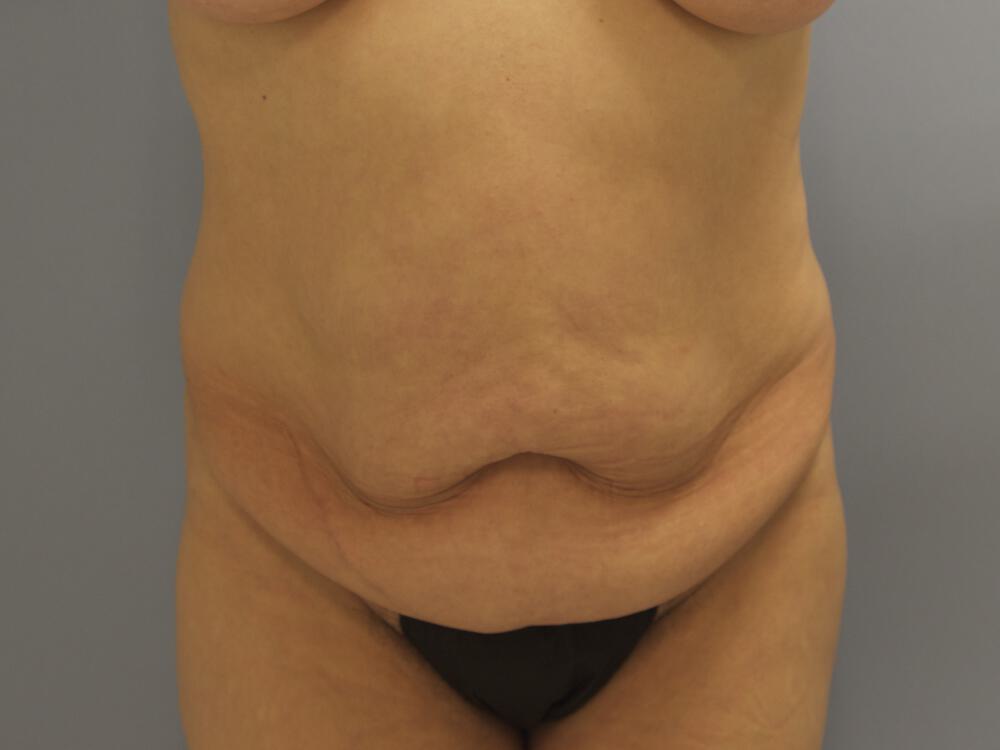 Tummy tuck Before & After Image