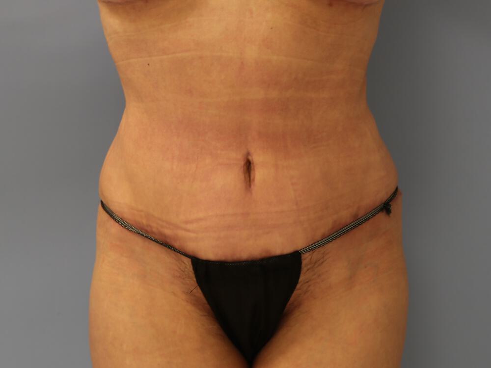 Tummy tuck Before & After Image