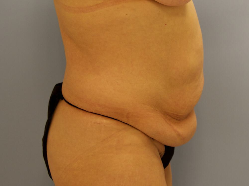 Tummy tuck Before & After Image