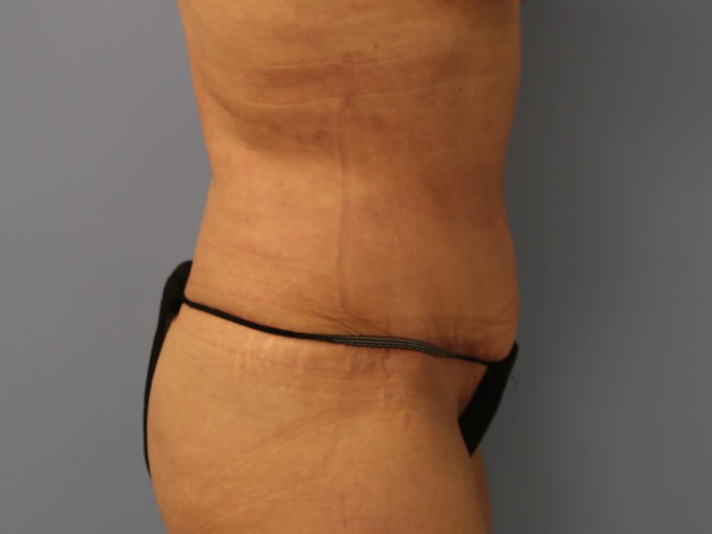 Tummy tuck Before & After Image