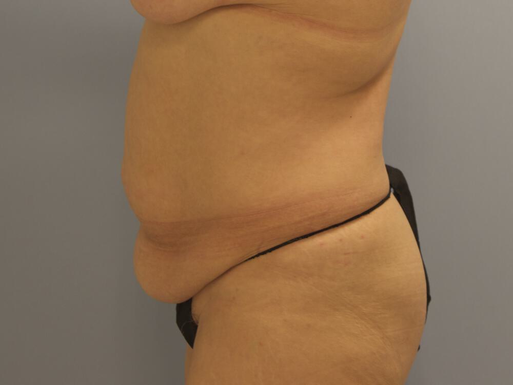 Tummy Tuck Before & After Image