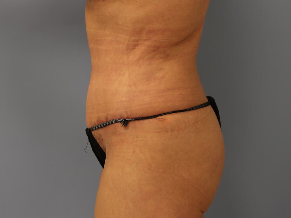 Tummy Tuck Before & After Image