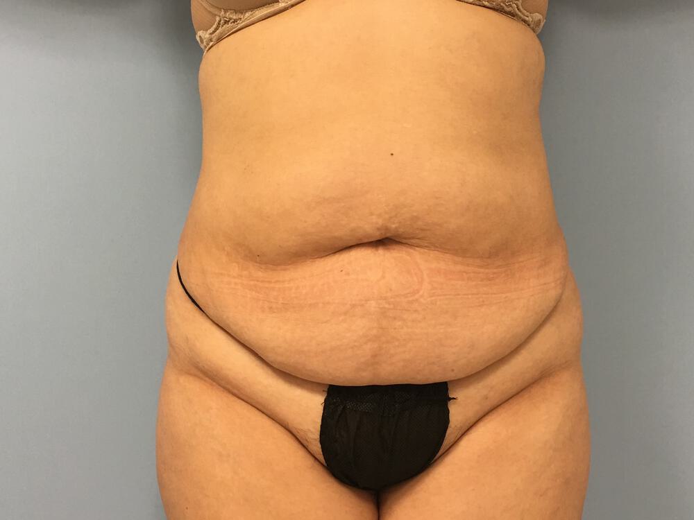 Tummy tuck Before & After Image