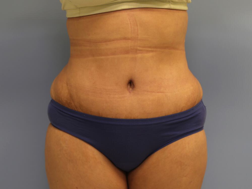 Tummy tuck Before & After Image
