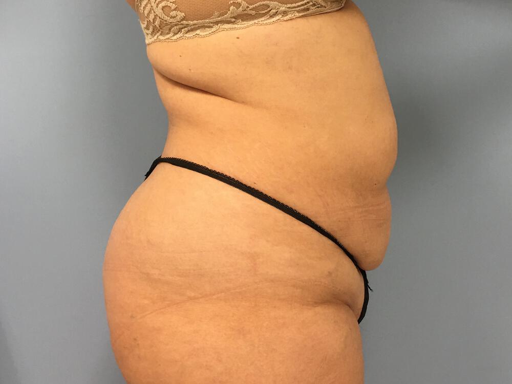Tummy tuck Before & After Image