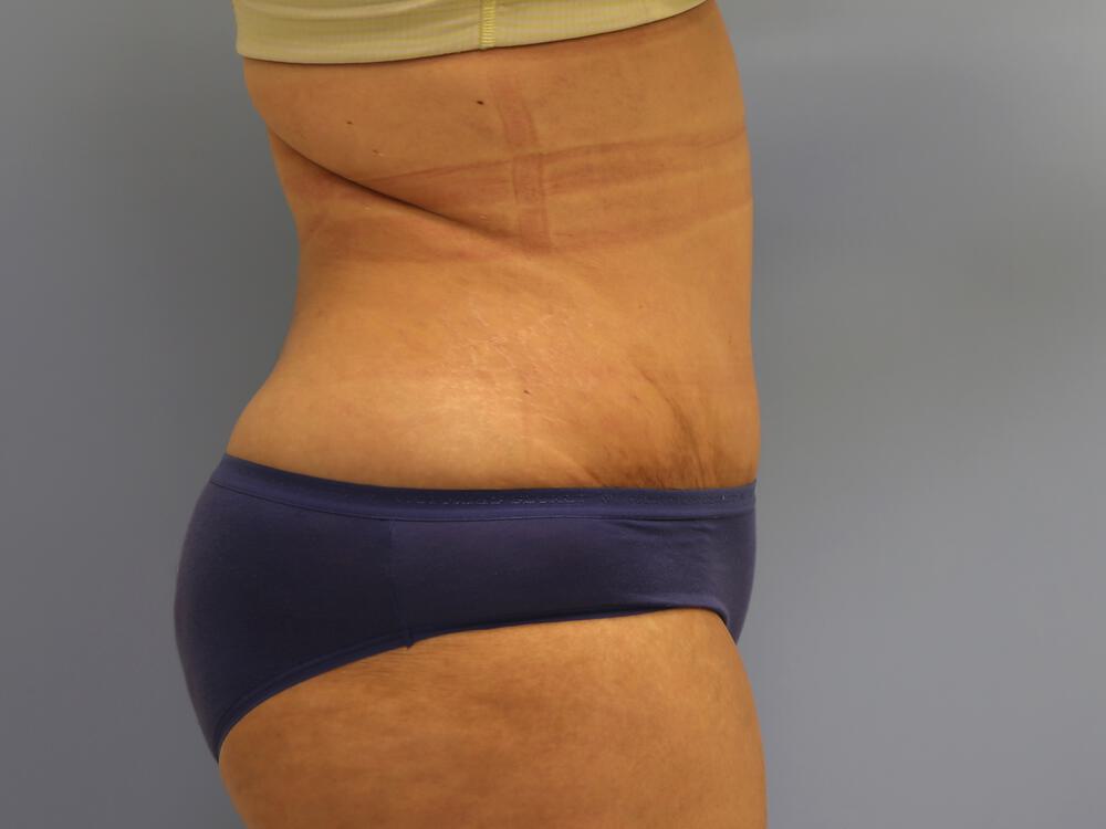Tummy tuck Before & After Image