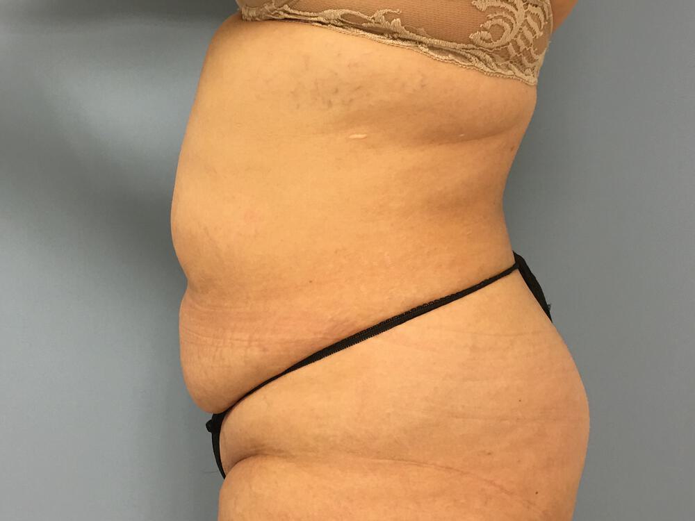 Tummy Tuck Before & After Image