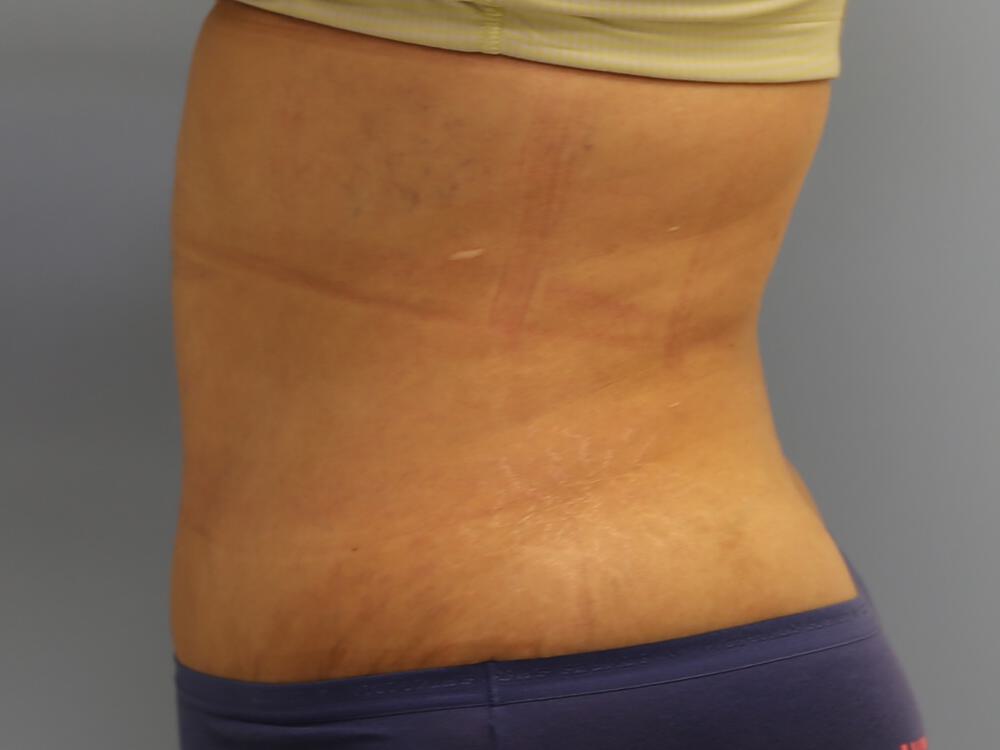 Tummy Tuck Before & After Image