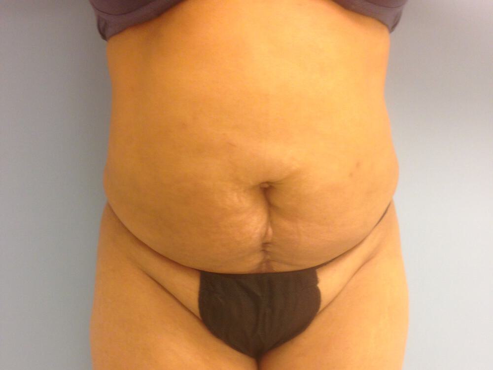 Tummy tuck Before & After Image