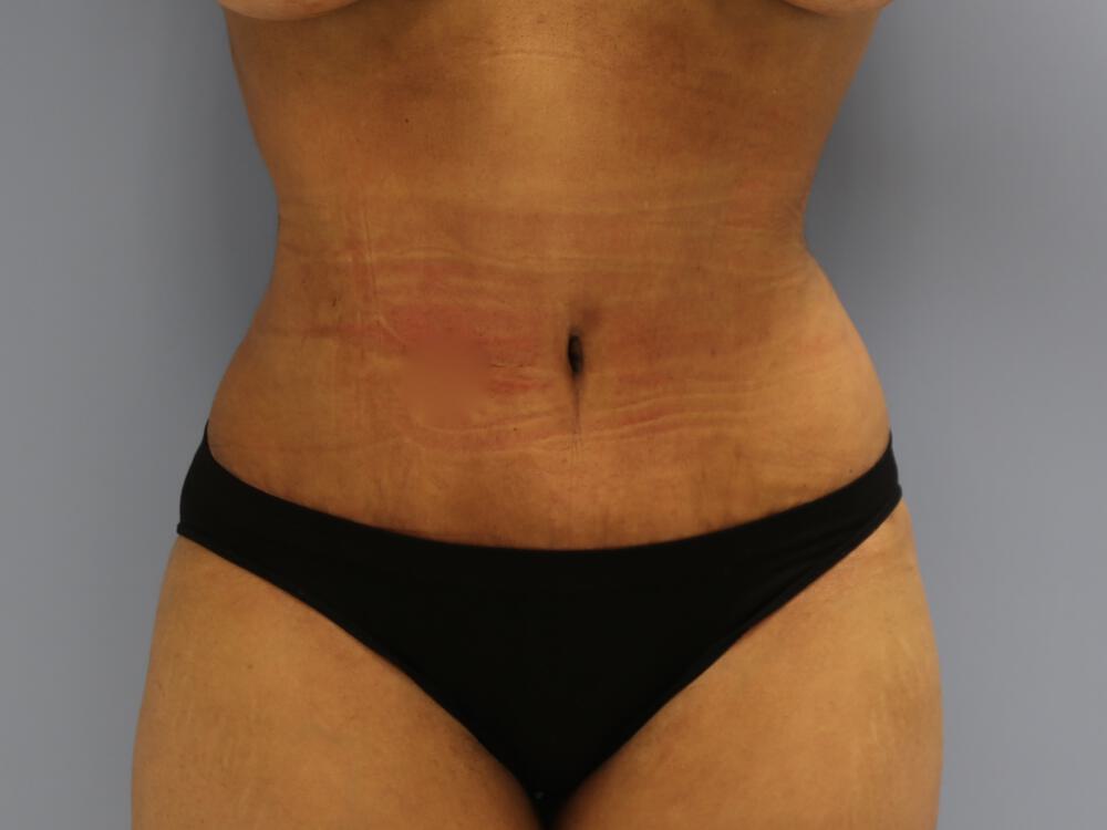 Tummy tuck Before & After Image