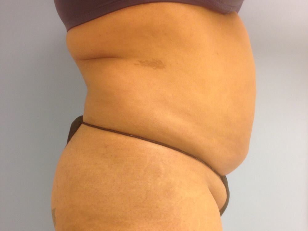 Tummy tuck Before & After Image