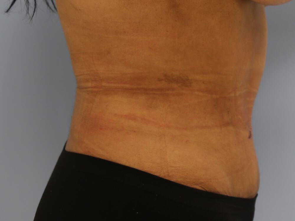 Tummy tuck Before & After Image