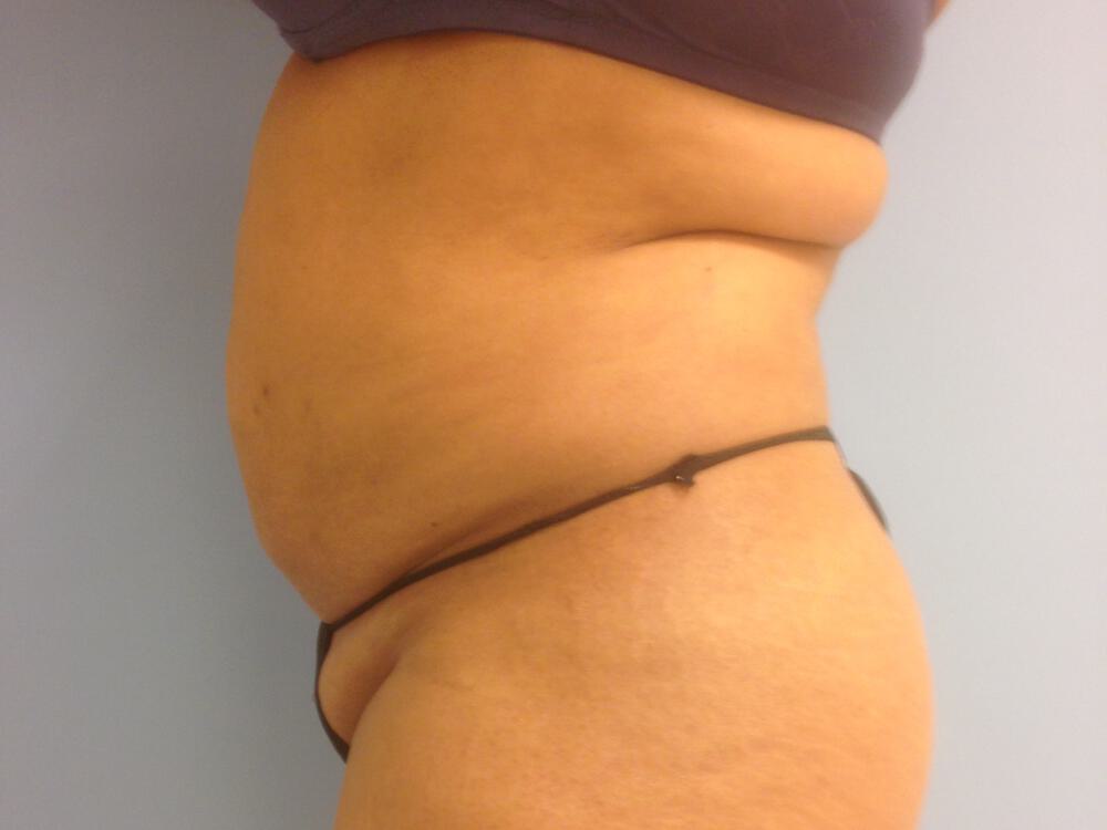Tummy Tuck Before & After Image