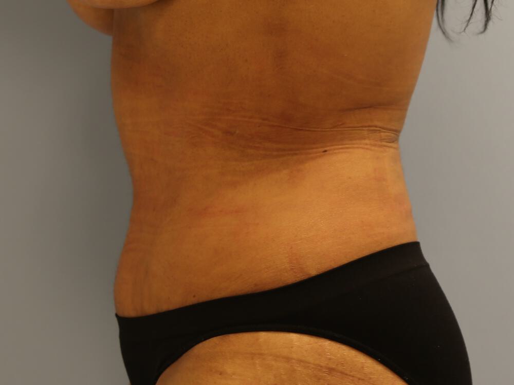 Tummy Tuck Before & After Image