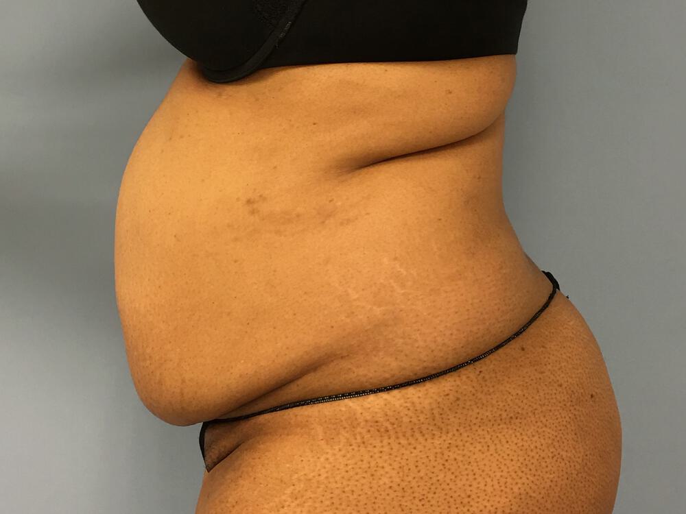 Tummy tuck Before & After Image