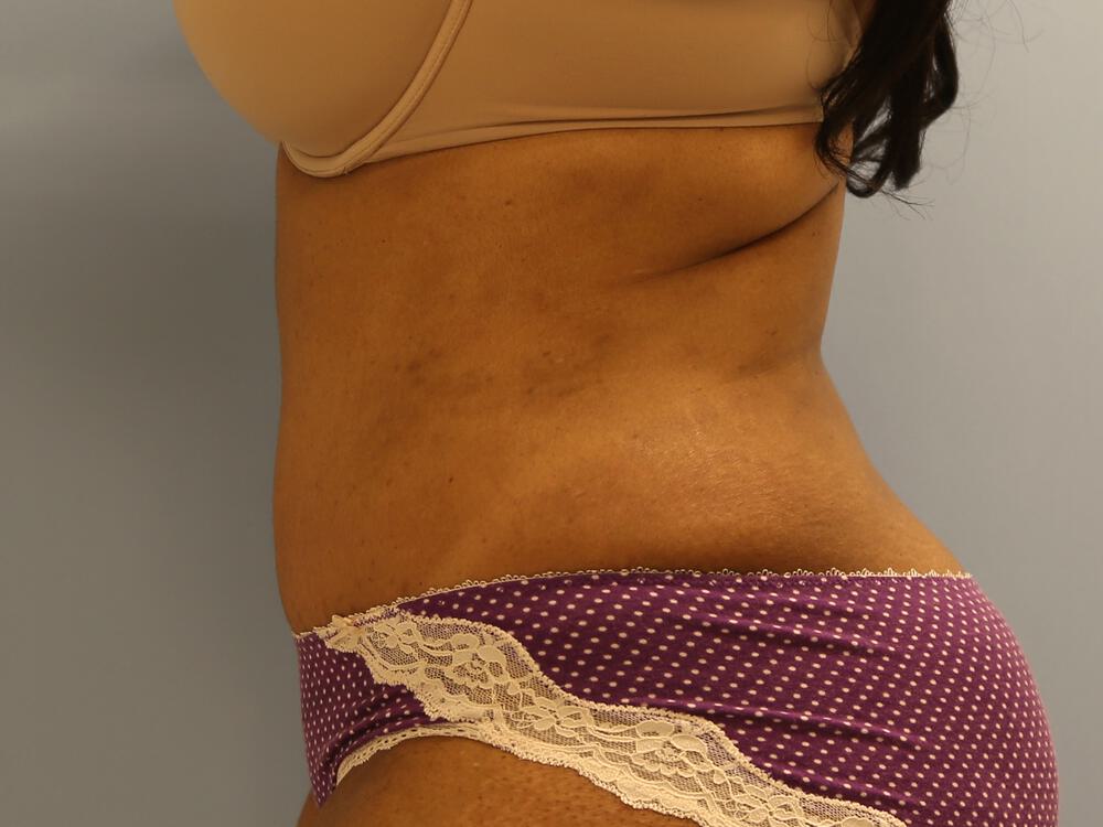 Tummy tuck Before & After Image