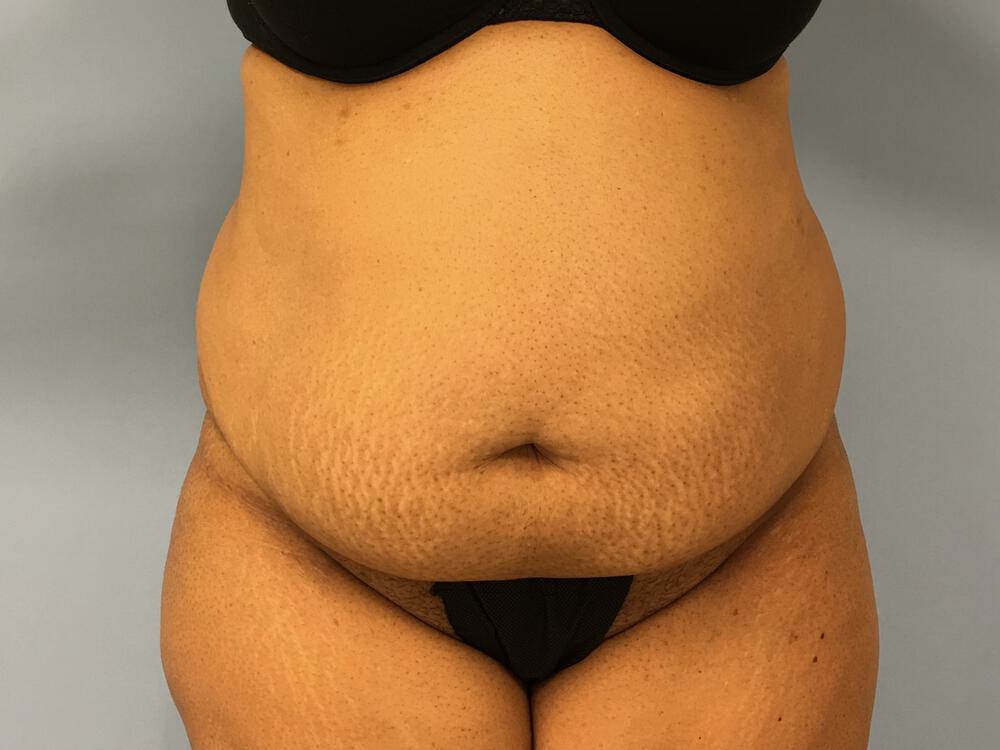 Tummy tuck Before & After Image