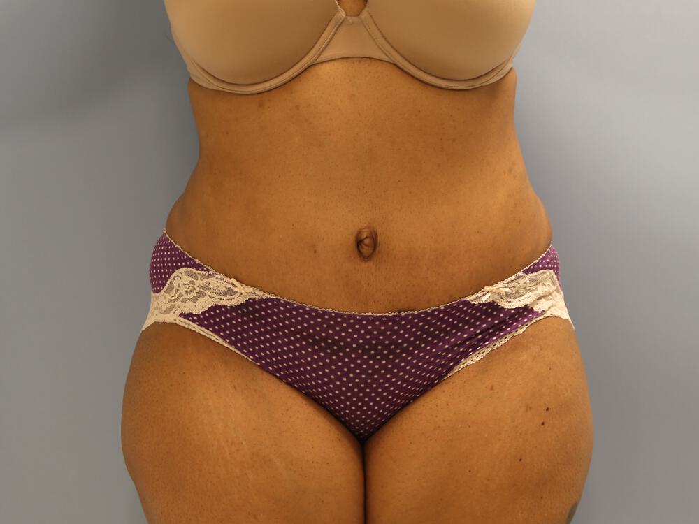 Tummy tuck Before & After Image