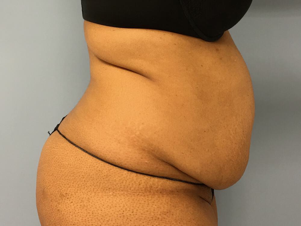 Tummy Tuck Before & After Image