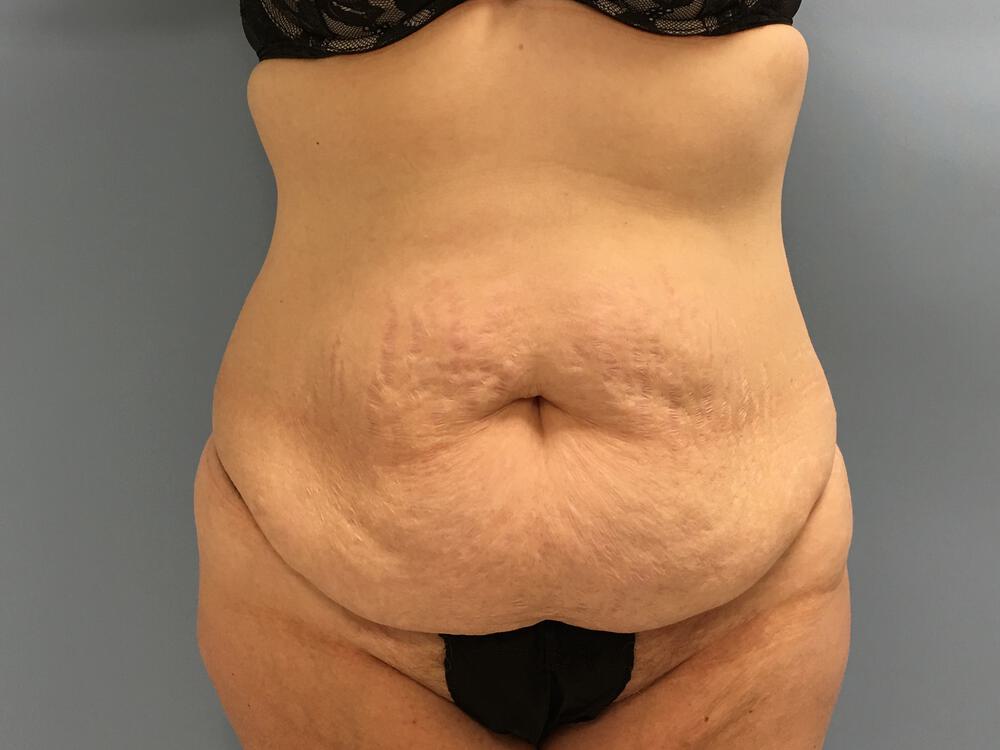 Tummy tuck Before & After Image
